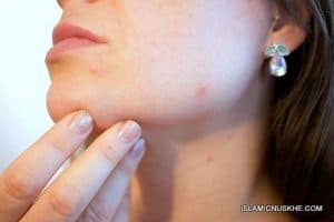 Dua or Wazifa to Help Cure My Acne Problem